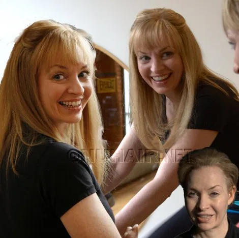 Female Hair Loss Dallas TX