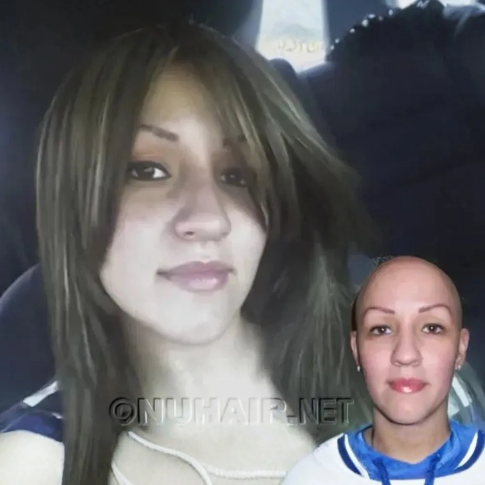 Female Hair Restoration Best Alopecia Wigs Dallas, TX